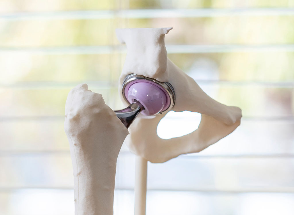 Hip joint, hip replacement, Hip Replacements and treatments